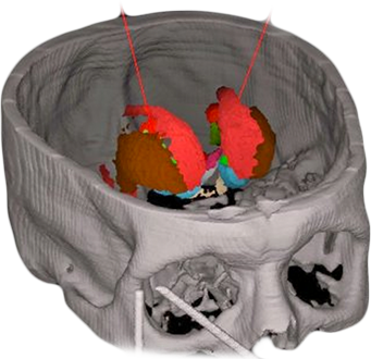MNPS - Sistema para Planejamento de Neurocirurgia Estereotáxica